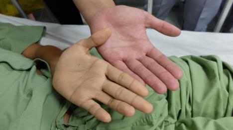 Upoređivanje zdrave ruke i one koja je žuto prebojena, koncept žutica