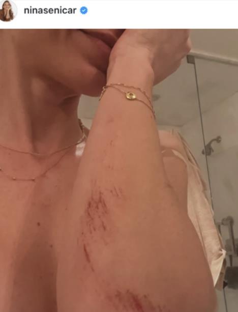 Nina Seničar se povredila