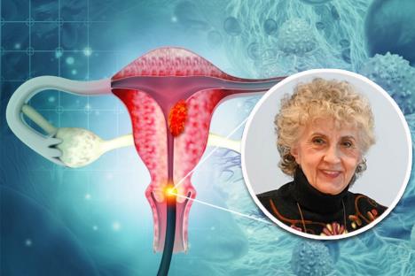 dr Vesna Kesić/grafički prikaz raka grlićamaterice