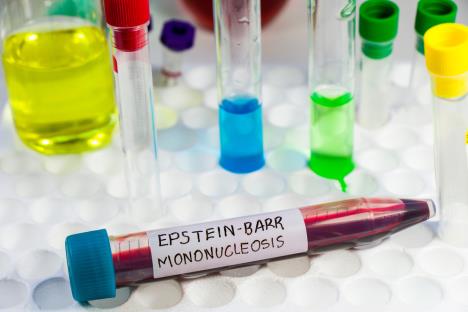 epruveta sa plavim poklopcem i nalepnicom na kojoj ej naznačeno Epštajn - Bar virus, mononukeloza