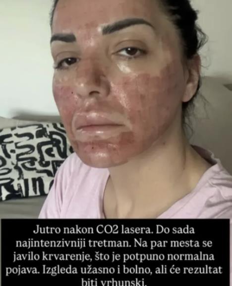 Zorica Erić sebi spalila lice