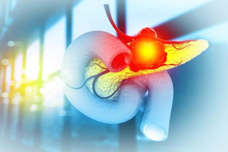 grafički prikaz raka pankreasa