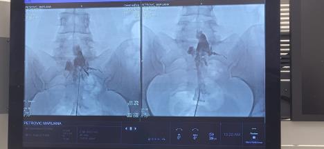 Epiduralna adhezioliza uspešno izvedena u UKC Vojvodine FOTO UKC Vojvodine 03.jpg
