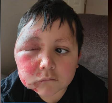 Dečak Kejleb Čabola dobio opekotine zbog TikTok trenda