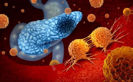 grafički prikaz raka pankreasa