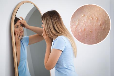 devojka u plavoj majci stoji ispred velikog ogledala i gleda kožu lica/milije male, bele izbočine na koži