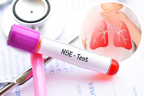 rak pluća/NSE marker