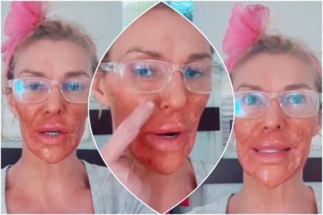 Brendi Glenvil sa ranama po licu