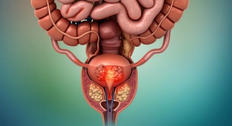 prostata rak prostate