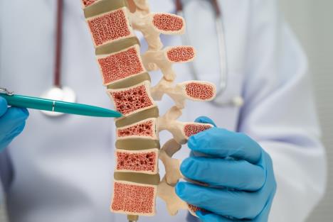 doktor pokazuje na model kičme koju je zahvatila osteoporoza