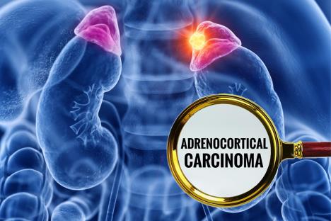 karcinom nadbubrežne žlezde, rak nadbubrežne žlezde