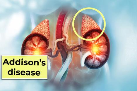 crtež bubrega sa nadbubrežnim žlezdama, natpis Adisonova bolest