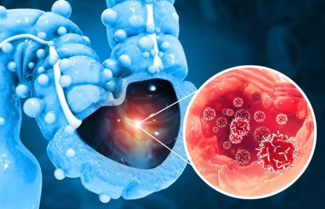 grafički prikaz raka debelog creva da izdvojenim detaljem u crvenoj boji