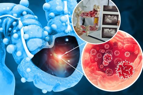 Rak debelog creva grafički prikaz/maketa sa snimcima skenera