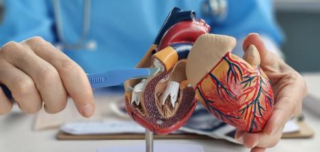 kardilog na modelu srca pokazuje ugradnju stenta