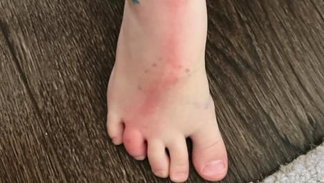 Majka je uočila da njen sin ima limfangitis, infekciju koja može da bude veoma opasna