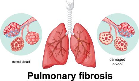 grafički prikaz zdravih pluća i pluća sa fibrozom