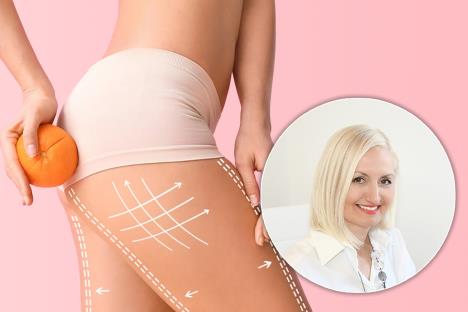 dr Jasmina Vikalo/noge mlade žene zahvaćene celulitom