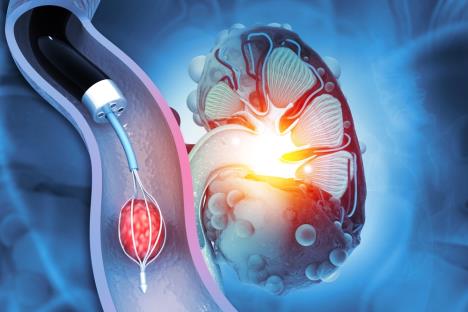 grafički prikaz vađenja kamena iz bubrega