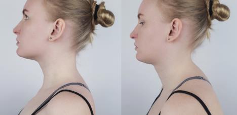 prikaz pre i posle devojka sa i bez grbe na vratu