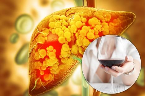 msna bolest jetre i konzumiranje alkohola