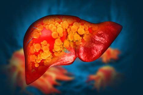 masna jetra tipa 1, početna faza