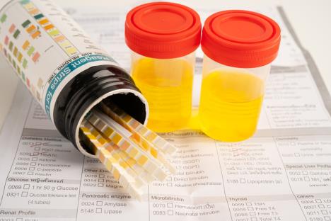 mešovita flora urin test