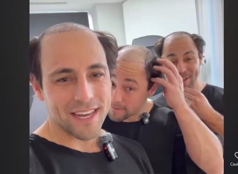 trojke, transplatacija kose