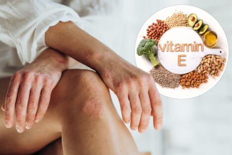 psorijaza/vitamin E