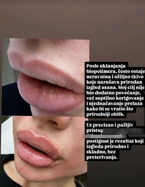 Milica Kemez  izvadila biopolimer iz usana