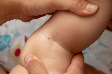 krpelj na telu deteta