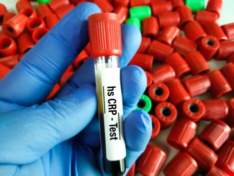 hs-CRP na epruveti, u pozadini crveni poklopci epruveta