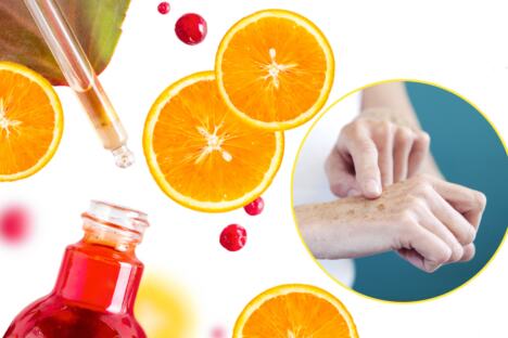 Vitamin C staračke pege hiperpigmentacija
