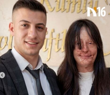 Berfin Ozek, udala se za bivšeg koji joj je bacio kiselinu u lice