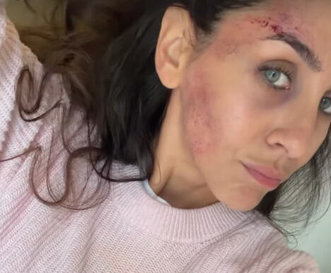 Ivana Dudić doživela nezgodu