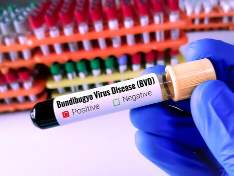 Bundibugjo virus test iz krvi, epruveta