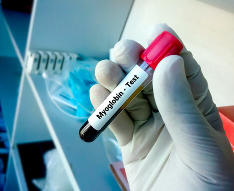 epruveta na kojoj piše mioglobin test