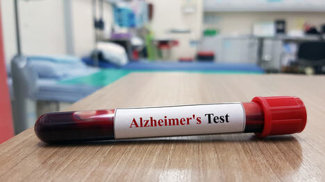 epruveta sa uzorkom krvi na stolu na kojoj piše Alchajmer test