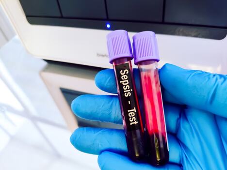 dve epruvete sa uzorcima krvi, na jednoj piše sepsa-test