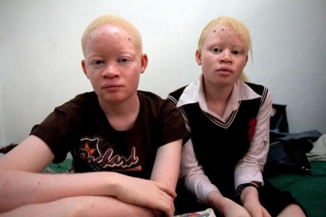 albino-tanzanija.jpg