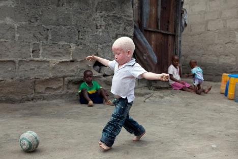 albino-tanzanija.jpg