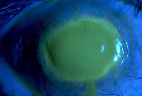 acanthamoeba-keratitis.jpg