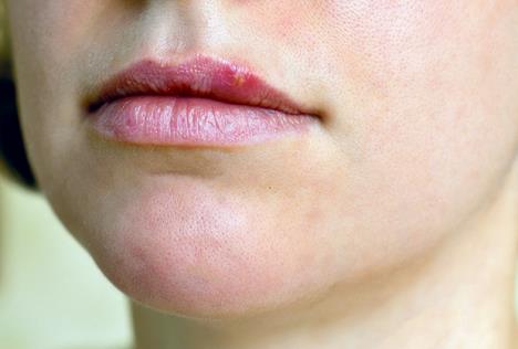 stockphotocloseupoffemalelipssufferingfromherpes225045721.jpg