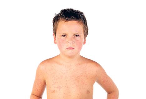 stockphotosickboychildwithredeyesandbumpsalloverhim4974943.jpg