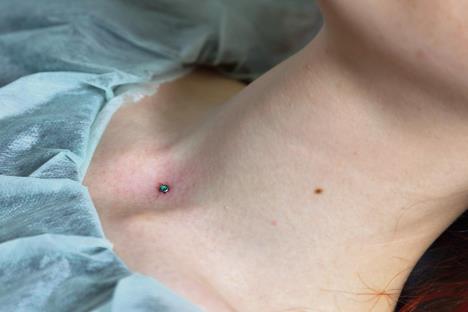 stockphotooperationtoinstallmicrodermalpiercing741946135.jpg