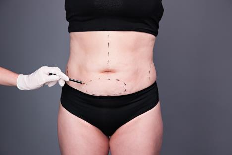 stockphotocosmeticsurgeryabdominoplastyfemaleabdomenliposuctioncellulitestreamersadultwomen362312609.jpg