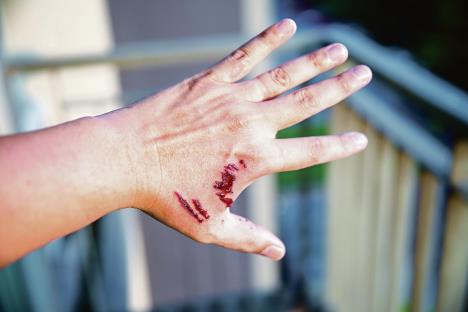 stockphotofocusdogbitewoundandbloodonhandinfectionandrabiesconceptpetcareandrabies1031474212.jpg