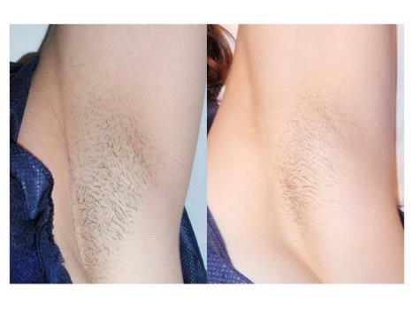 armpits-before-and-after.jpg