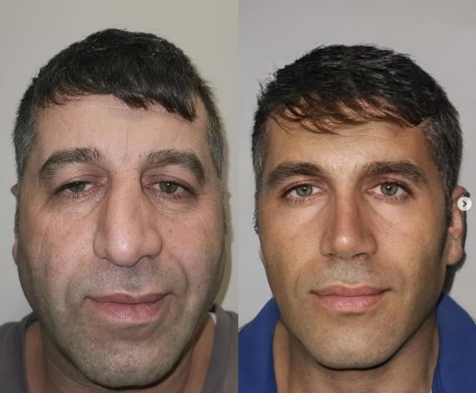 Muškarac pre i posle estetskih operacija lica – potpuno drugačiji izgled nakon osam meseci tretmana u Turskoj.