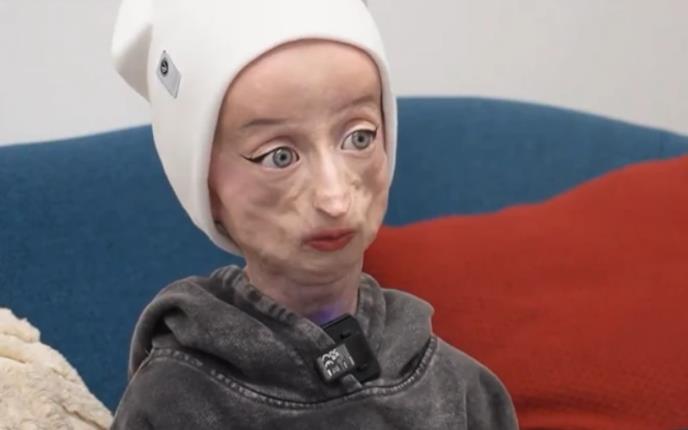 Anja Korčagina, devojka čiji je život obeležen progerijom